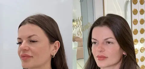 Antes e depois de uma paciente: rosto mais harmônico e natural